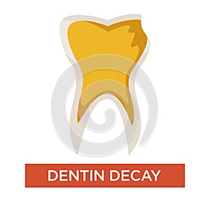 Dentin decay isolated dental care and medicine dentistry