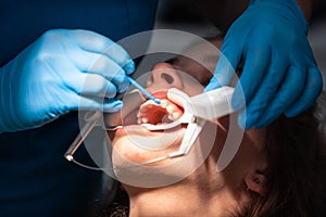 Dentist appointment at a dental clinic, placing braces locks on the teeth and pulling the archwire to fix it