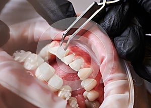 Dentist attaching orthodontic brackets to patient teeth.