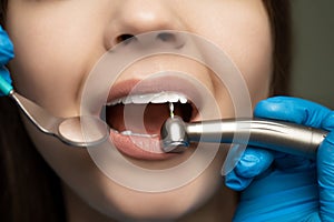 Dentist in blue gloves filling the patient`s root canal under the medical lamp in clinic close up, healthcare concept