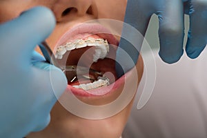 Dentist checking bracket at the braces on the female patient. Close-up. Real People.