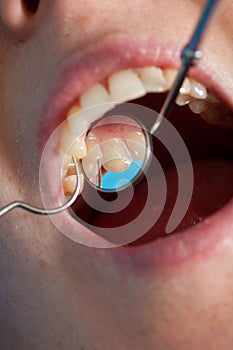 Dentist checking for cavities