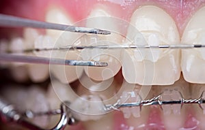 Dentist checking up teeth with ceramic brackets, using reverse tweezers. Macro shot of teeth with braces