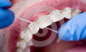 Dentist cleaning teeth with ceramic brackets, using floss at the dental office. Macro shot of teeth with braces