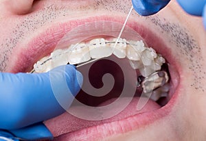 Dentist cleaning teeth with ceramic brackets, using floss at the dental office. Macro shot of teeth with braces