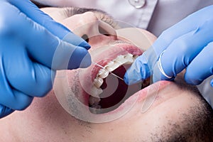 Dentist cleaning teeth with ceramic brackets, using floss at the dental office. Macro shot of teeth with braces