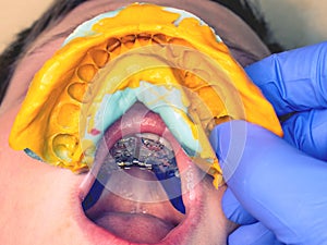 Dentist compare teeth correction and imprint