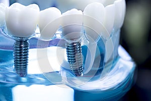 Zubní zuby implantát 