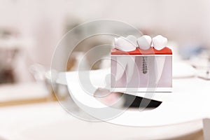 Dentist dental teeth teaching model showing titanium metal tooth implant screw. Generic Dental Implant Study Analysis Crown Bridge