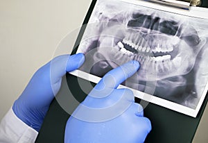 A dentist doctor examines a radiography of the teeth of a patient who has problems and teeth are inserted. The concept of research