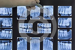 dentist doctor, oral x-ray examinations (oral x-ray)
