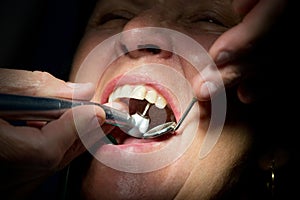 Dentist drilling teeth