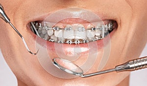 Dentist examining the braces of the system on the teeth of a young beautiful woman in a dental clinic. Correction of malocclusion
