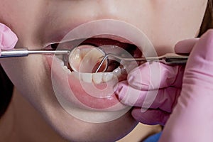 Dentist examining patient teeth with a mouth mirror and dental excavator. Close-up view on the woman