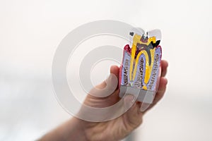 Dentist hand holding plastic model of human tooth stricken with caries on light background