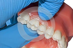 Dentist hand show invisible orthodontic aligner