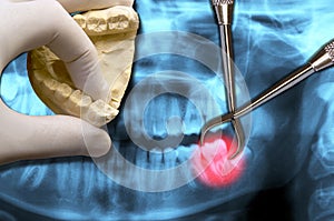 Dentist hand show molar tooth photo