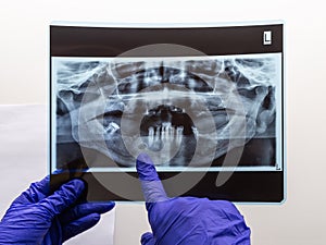 The dentist hand show problem area in the lower jaw bone on a panoramic x-ray of an old person with only a few teeth left in his