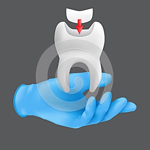 Dentist hand wearing blue protective surgical glove holding a ceramic model of the tooth. 3d realistic vector illustration of