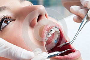 Dentist hands working on dental braces.