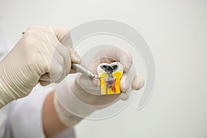 Dentist holding educational model of tooth