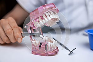 Dentist implantologist showing dental bridge implant technology on human tooth jaw model