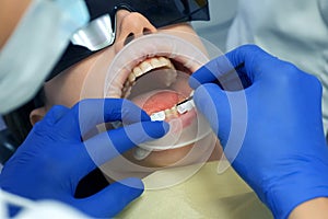 Dentist is preparing woman's teeth for installing ceramic veneers and crowns.