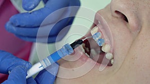 Dentist puts base for placing dental veneers