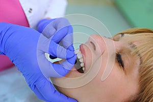 Dentist puts dental veneers patient
