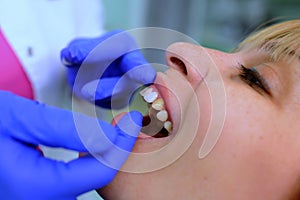 Dentist puts dental veneers patient and correction of teeth