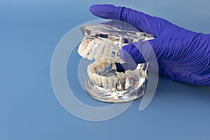 Dentist& x27;s Hand Holds Study Standard Typodont or Periodontal Disease Teeth Model in