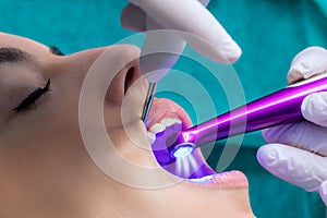 Dentist setting fissure sealant with led curing lamp on patient.