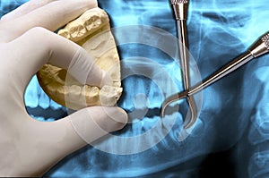 Dentist show molar tooth extraction photo
