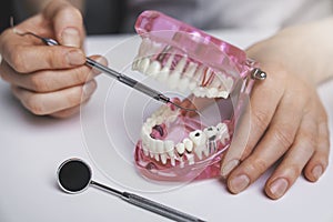 Dentist showing dental caries tooth decay on jaw model