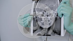 Dentist showing problem zones in the mouth using X-ray of the teeth