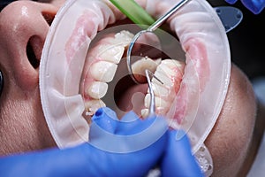 Dentist in sterile gloves examining woman teeth.