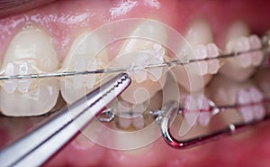 Dentist treating teeth with ceramic brackets, using mosquito at the dental office. Macro shot of teeth with braces