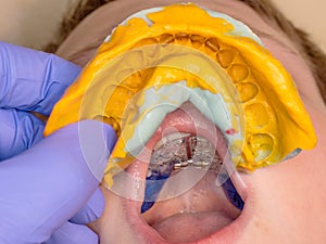 Dentist use dental impression for check braces