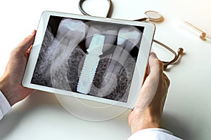 Dentist watching a dental x-ray teeth with dental pivot on digital tablet. Radiology concept