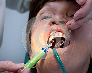 Dentist working on teeth