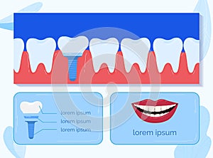 Dentistry dental, tooth mouth, dentist medicine, medic health, implant root, dentin crown, design, flat style vector