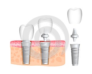 Dentistry. Dentistry. Realistic dental implant structure with all parts: crown, abutment, screw. Implantation of human teeth. Vect photo