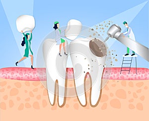 Dentistry. Doctors treat teeth affected by caries. Enamel damage, tooth infection, bacteria. Dentistry, treatment of toothache. Ve