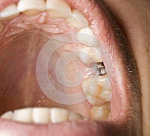 Dentistry implant