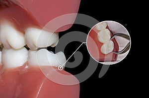 Dentistry surgery extraction tooth photo