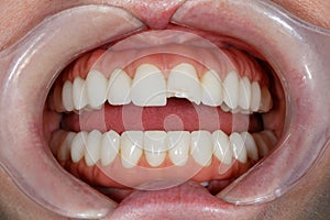 Dentistry of teeth before treatment. Close-up photo of teeth. Image of teeth whitening. Treatment plan for a new smile. Making