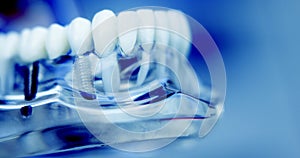 Zubaři zubní zuby implantát 