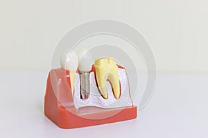 Dentsts dental prosthetic teeth, gums, roots teaching student model with titanium metal implant.tooth model