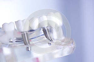 Dentsts dental tooth implant