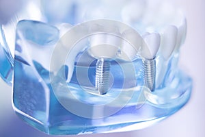 Zubní zub implantát 